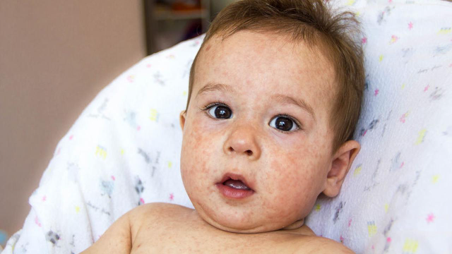 Mengenal Eksim: Penyebab, Pengobatan, dan Cara Mencegah Kekambuhan